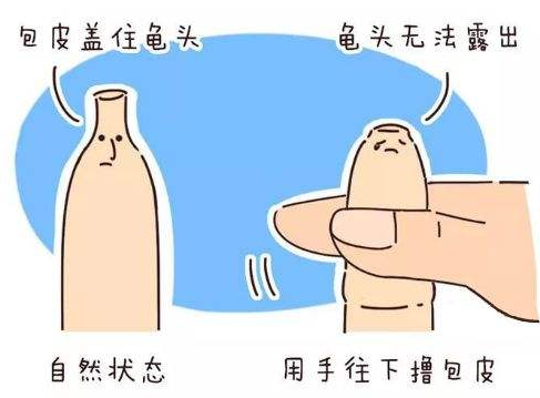 男性包茎具体有哪些危害