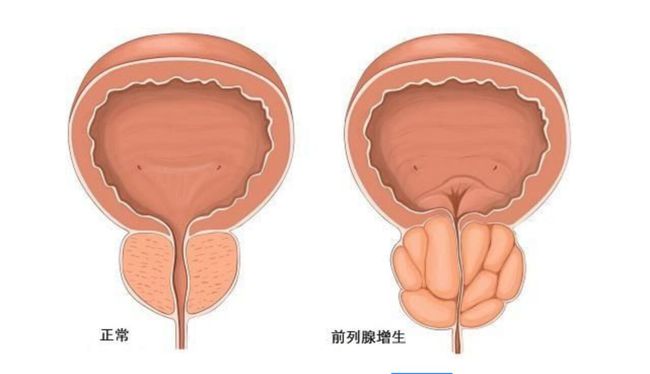 前列腺增生通常有什么症状